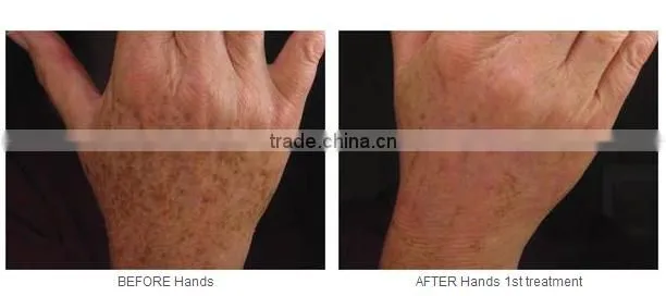 PTP Q Switch laser hair removal long pulse nd yag pigment tattoo removal machine yag picosecond laser