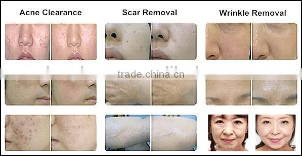 fractional co2 laser equipment for scar removal and skin resurfacing