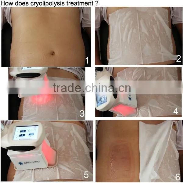 2014 best portable cryo cryolipolysis lipo laser, cryolipolysis lipo laser portable