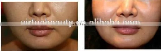 Virtue beauty facelift RF Fractional Thermal Machine