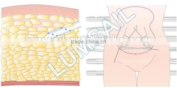 Professional Tumescent Liposuction surgical liposuction Slimming Body Lifting Machine