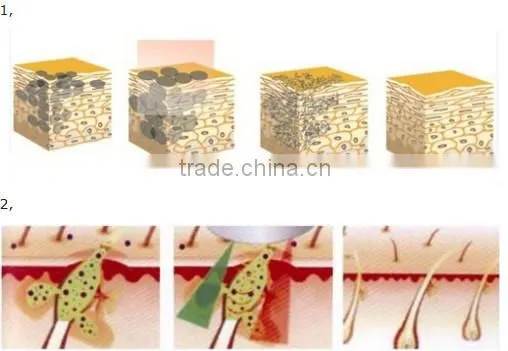 Permanent hair removal painless protable ipl skin treatment system