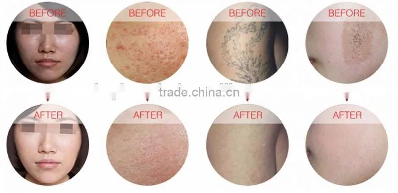 Whosale portable beauty machine nd:yag q-switch 532nm laser machine remove tattoo