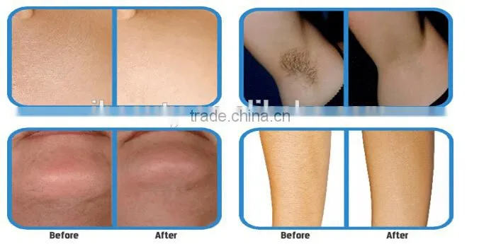 shr ipl hair removal machine/super hair removal/ipl shr +elight