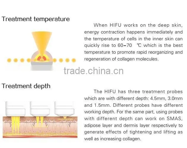 cavitation hifu / hifu system / hifu transducer