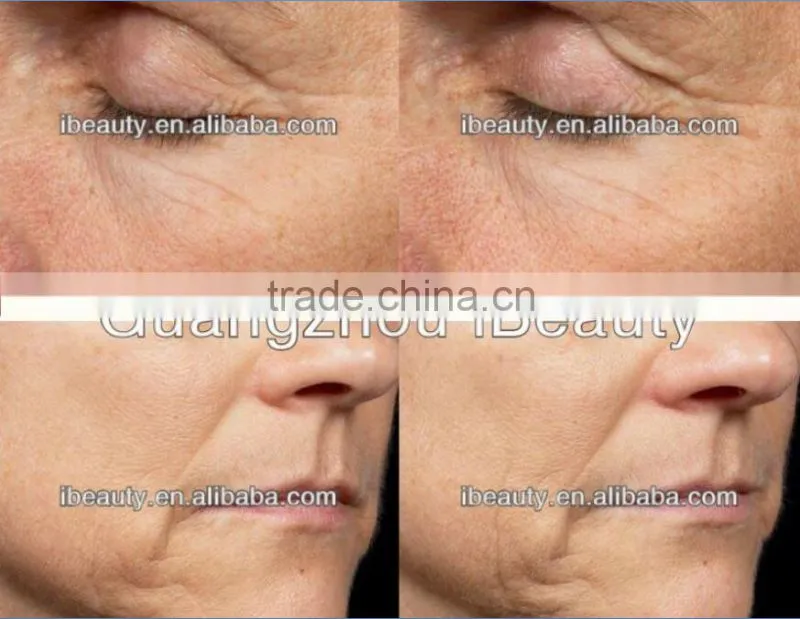 Effective RF Shaper Skin Tightening Machine for Home Use fractional RF