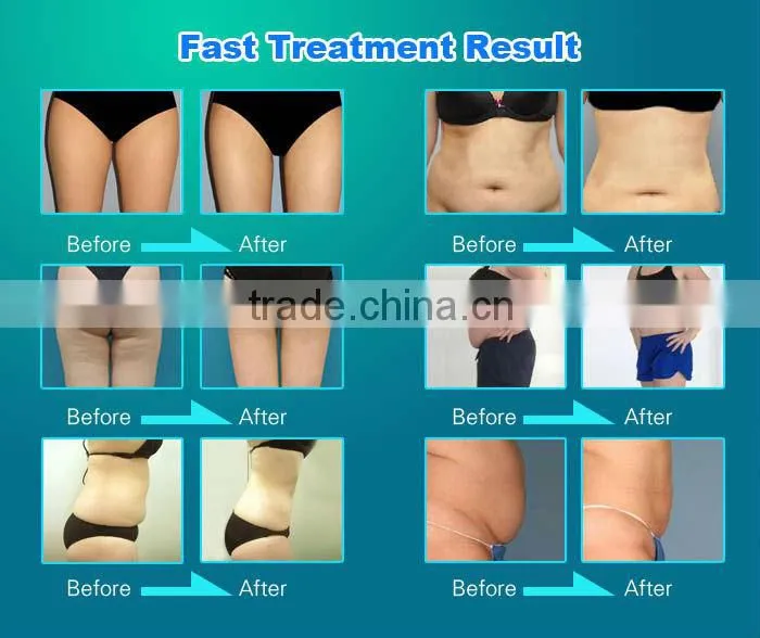 cavitation vacuum anti cellulite device