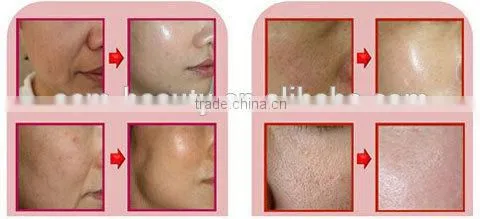 Fashional 4 in 1 derma roller,micro needle roller in 2016 year -L013C