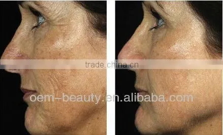 ipl Professional Hair Removal Machine portbal ipl hair removal shr ipl