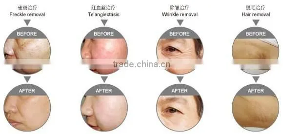 Hot selling!!! ipl new skin rejuvenation machine
