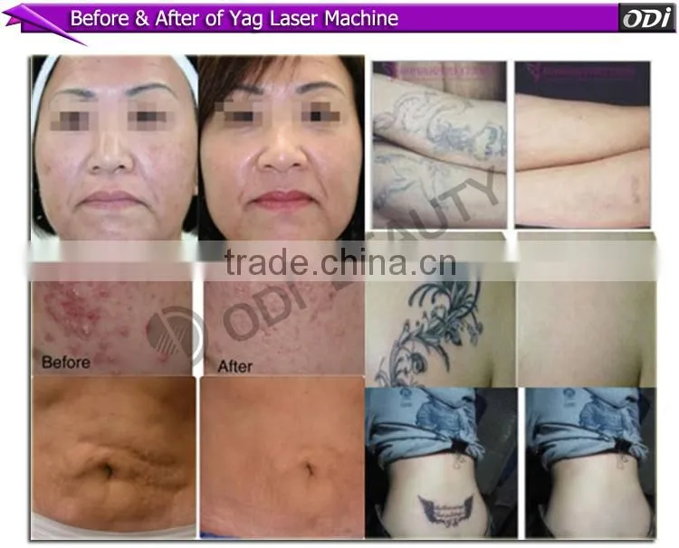 Strong articulated arm laser nd yag single pulse pigment removal laser machine