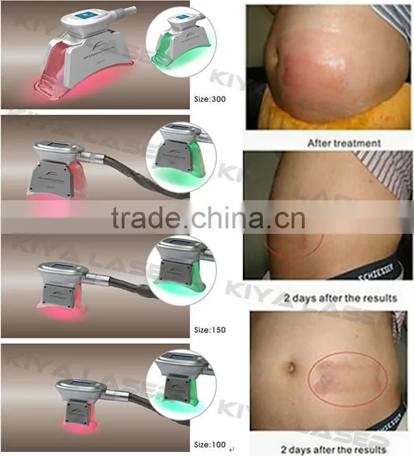 2016 most popular freezing fat procedure
