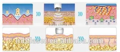 Professional RF wrinkle removal beauty machine of radio frequency machine for salon use