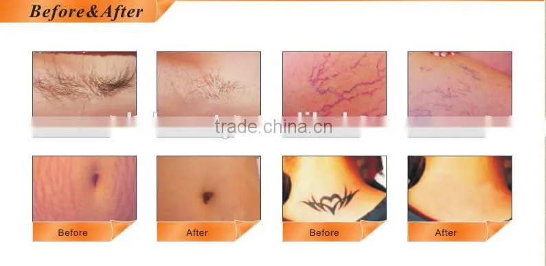 Hot Promotion! Electric Permanent Painless Lazer IPL Hair Removal Machine Cheap IPL