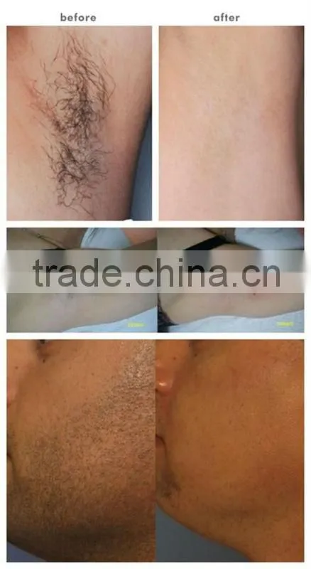 long pulse nd yag laser with skin contact cooling system P-C01