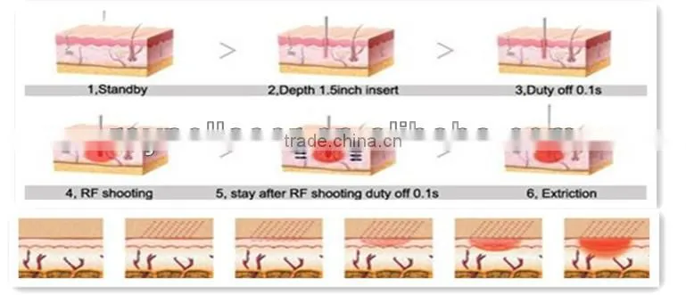 Stretch Mark Removal Micro Needle Fractional RF Radio Frequency Beauty Equipment