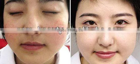 High quality Q-switch nd yag tattoo removal laser for legs women and men with good price D001