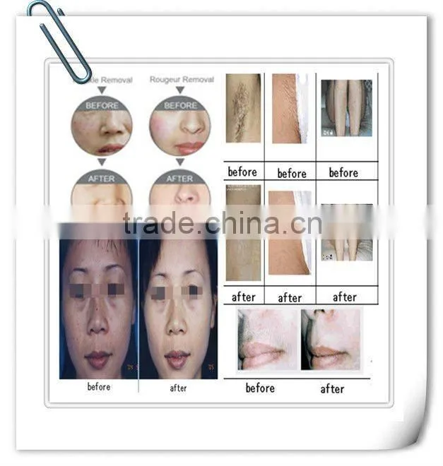 E5B best selling e light ipl rf system shr hair removal