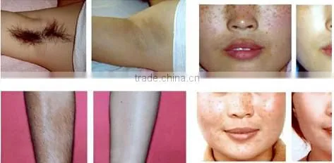 Top sale Beauty machine elight IPL RF for hair removal and skin care