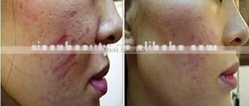 Power Line and Changeable Heads LED Light Microneedle Derma Rolling