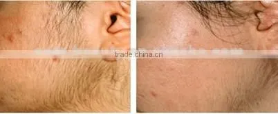Face and Body Home IPL Hair Removal System ipl lamp with 100,000 shots