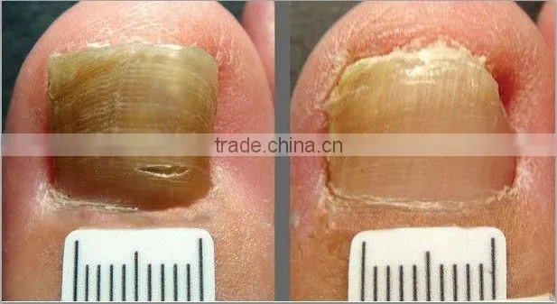 1064nm nd yag laser for nail fungus lasylaser V18