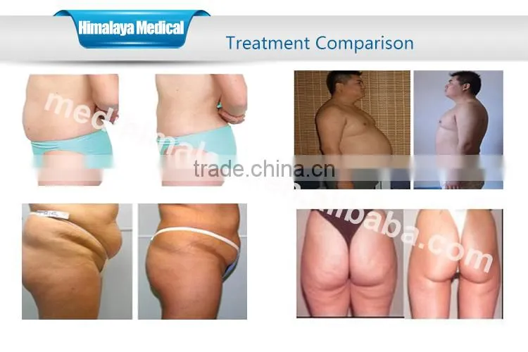 Comfortable fat freezing 4 cryo cryotherapy cryotherapy fat removal