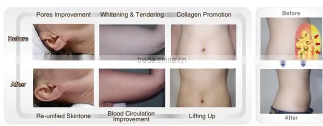 T&B 5 in 1 slimming cavitation dermo vacuum rf roller photon machine