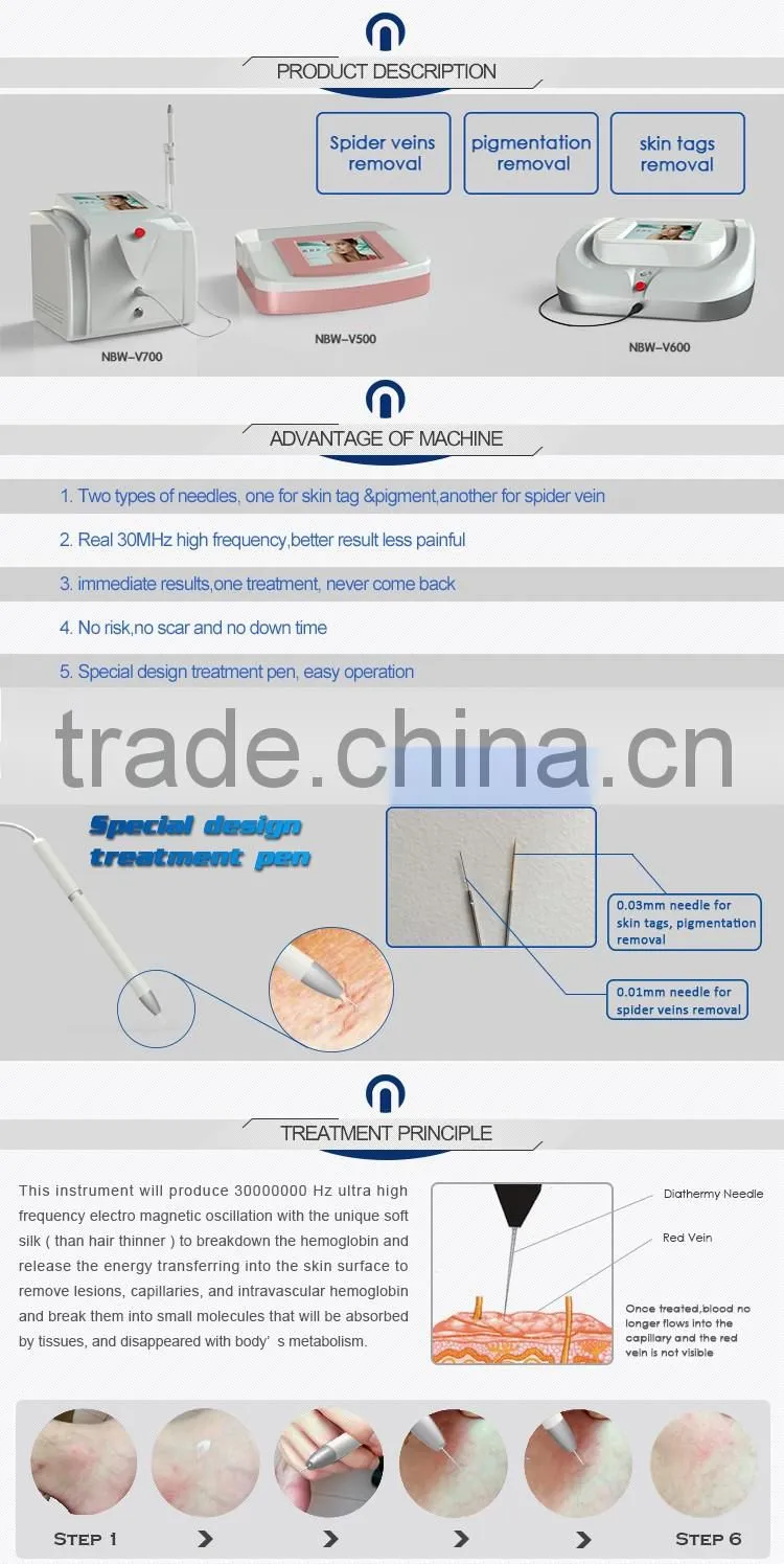 30MHz RBS maquina para quitar varices & machine to remove varicose veins