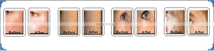 12 Years Professional Beauty Machine Manufacturer Depilation E-light Skin Rejuvenation shr