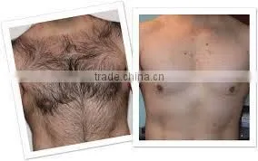 The factory low price promotions! Professional diode laser/808nm diode laser/laser hair removal for permanent hair removal