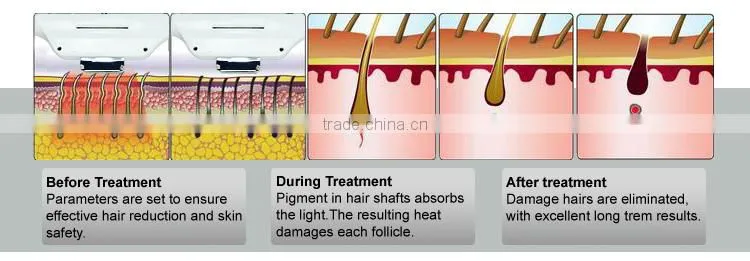 Portable elight opt fast hair removal skin rejuvenation IPL device