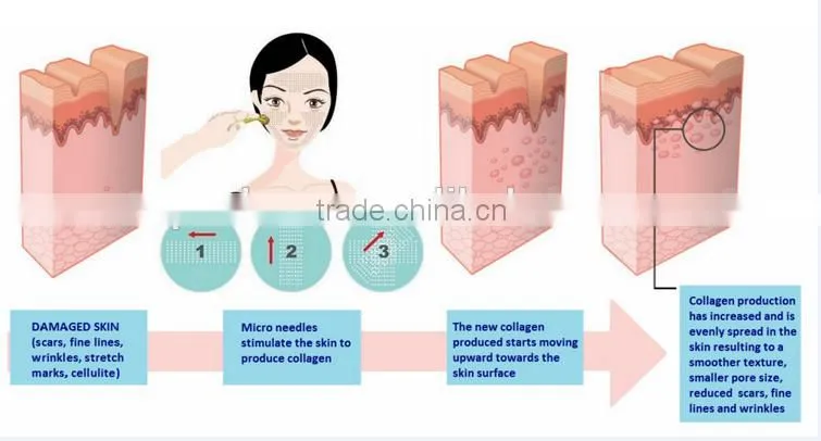 2016 best micro needle derma roller 540 dermaroller