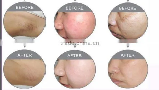 Elight Laser SKin Photo Revenation Machine C009