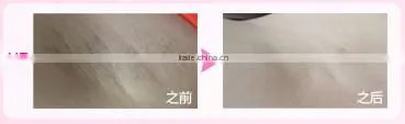 Laser skin machine hair removal device for permanent hair removal skin rejuvenation and acne clearance with 3 lamps