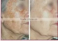 Q switch nd yag laser skin age spot removal machine