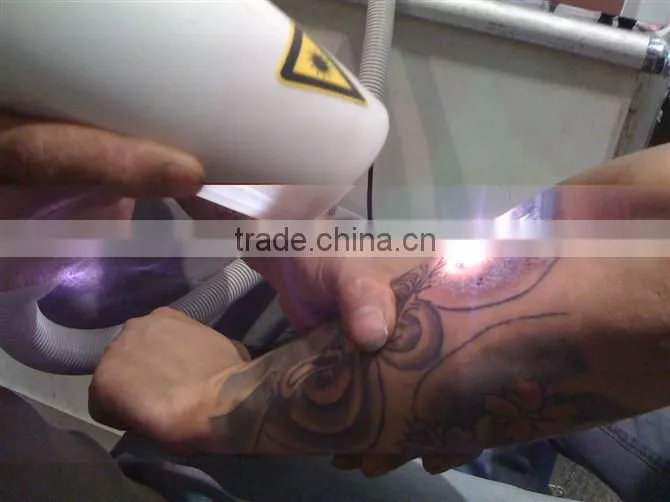 2014 NEW innovative beauty latest tattoo machines nd yag ktp laser OB-TR 02
