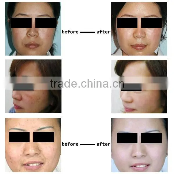 Cheap portable laser machine part balck dool for pigment removal
