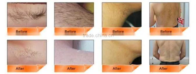 ipl shr machine / shr ipl hair removal machine pain free