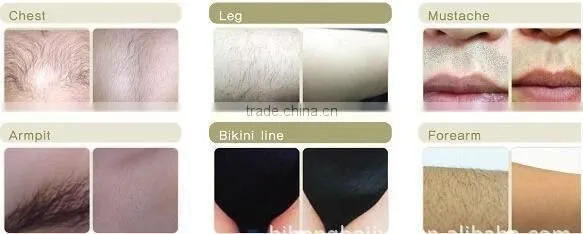 Free pain 808 diodo lazer hair removal machine 808nm