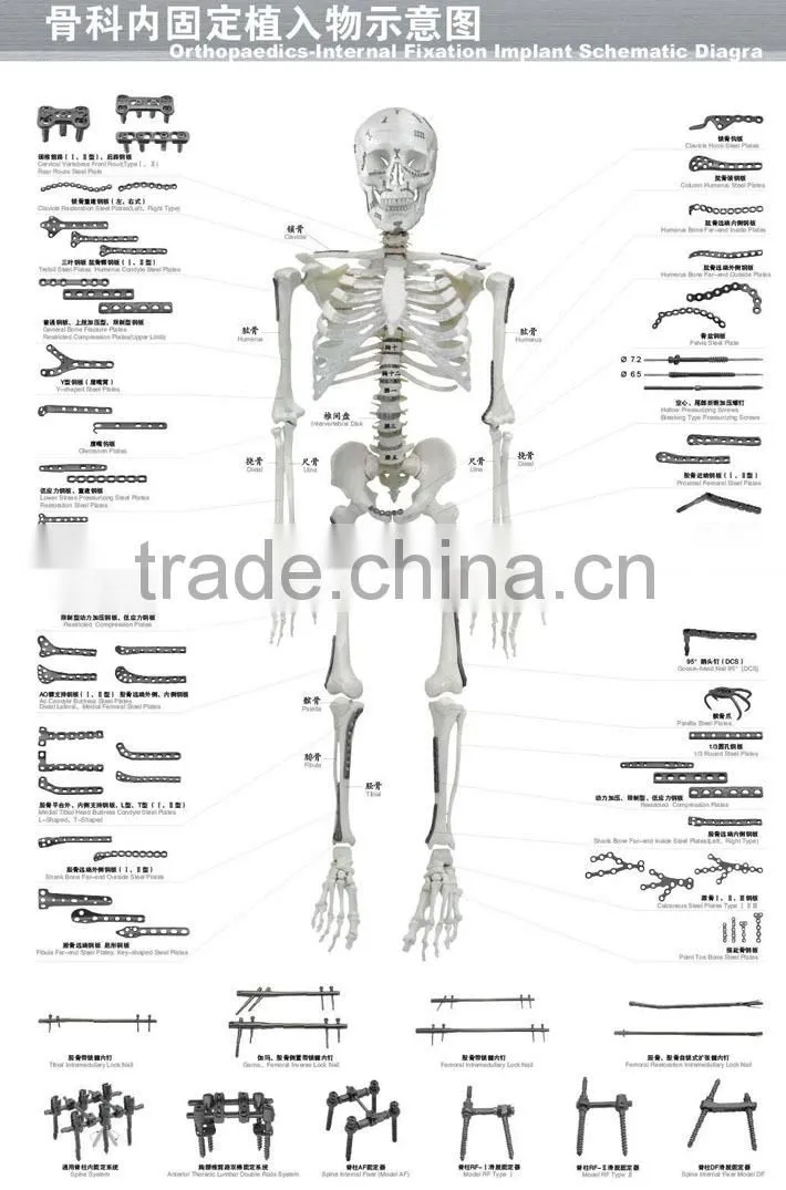 I type Eternal fixation surgical instruments Spinal Implant For Rf Spinal Fixation System