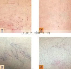 aimed middle & high-ended market! 30MHz radio high frequency skin care