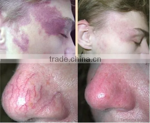 980nm vascular laser removal diode laser 980nm