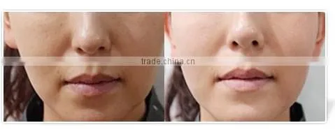 Professional Injection Meso Mesotherapy Gun For Skin Whitening Wrinkle Removal