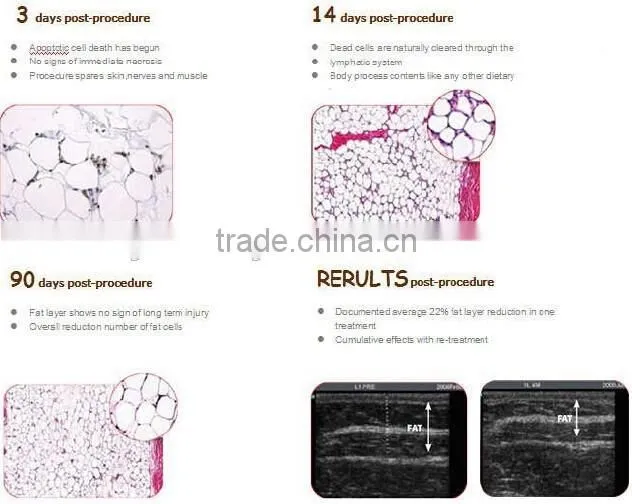 Profession body slimming and cellulite treatment machine
