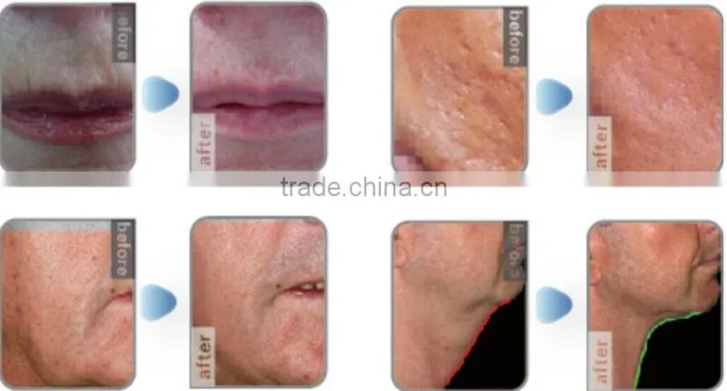 promotion shr hair removal hair removal ipl machine