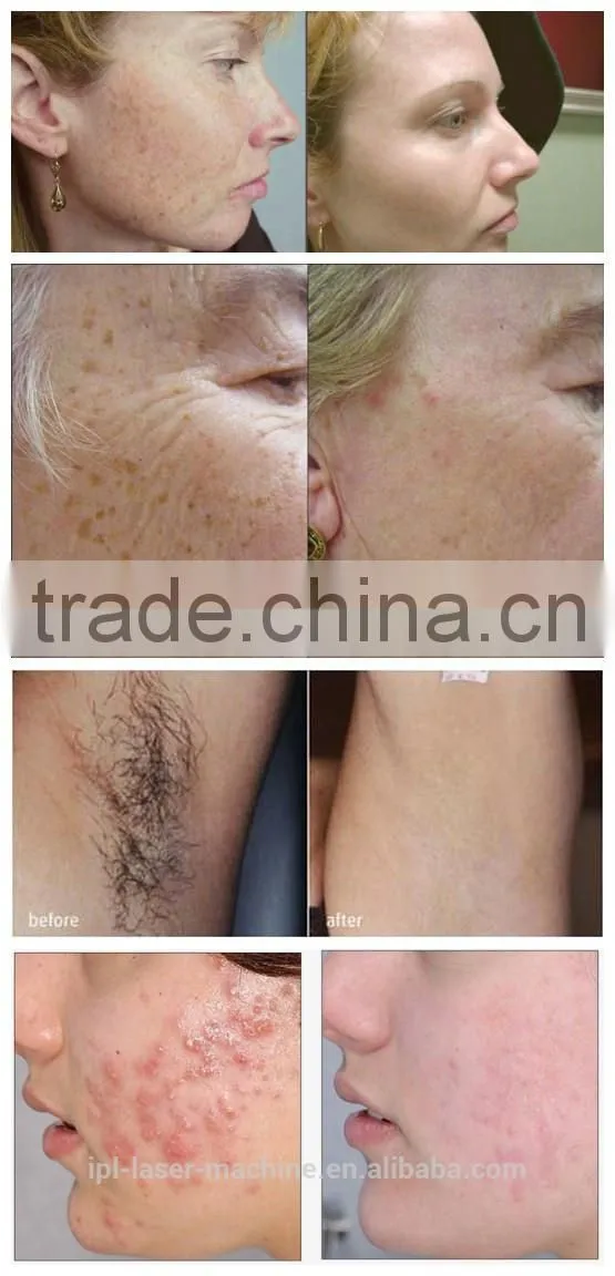 Biggest specials! ipl machine/ ipl hair removal/korea ipl machines