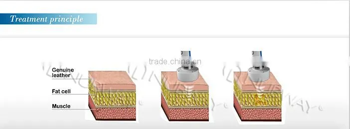 High intensity focused ultrasound body slimming HIFUSHAPE hifu transducer