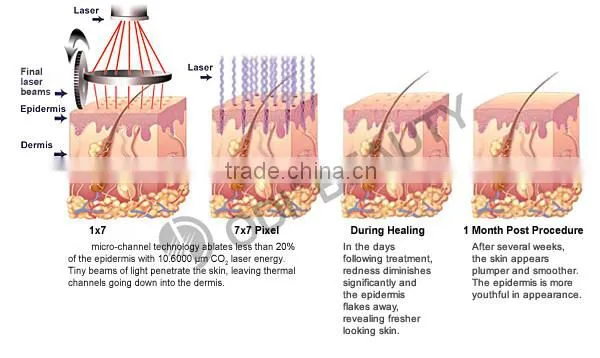 OD-V8 Professional fractional co2 laser treatment with beautiful vaginas
