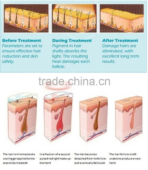 CE Approved Best Home Use IPL Photofacial Machie / Laser Hair Removal Varicose Vein Laser IPL